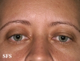 blepharochalasis-unilateral blepharochalasis