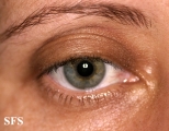 blepharochalasis-unilateral blepharochalasis