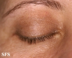 blepharochalasis-unilateral blepharochalasis