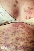 herpes gestationis