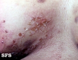 herpes gestationis