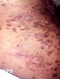 herpes gestationis