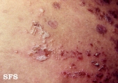 herpes gestationis