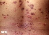 herpes gestationis