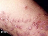 herpes gestationis