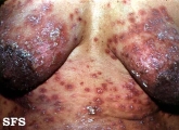herpes gestationis