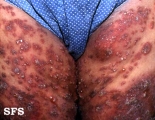 herpes gestationis