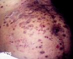 herpes gestationis