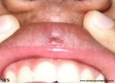 syringoma-lip_syringoma