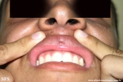 syringoma-lip_syringoma