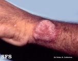 tuberculosis verrucosa cutis