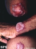 tuberculosis verrucosa cutis
