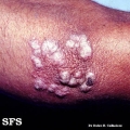 tuberculosis verrucosa cutis