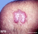 tuberculosis verrucosa cutis