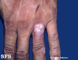 tuberculosis verrucosa cutis