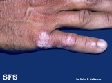 tuberculosis verrucosa cutis