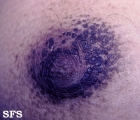 hyperkeratosis_of_ the_nipple_and_ areola