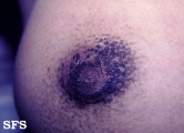 hyperkeratosis_of_ the_nipple_and_ areola