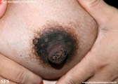 hyperkeratosis_of_ the_nipple_and_ areola