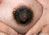hyperkeratosis_of_ the_nipple_and_ areola