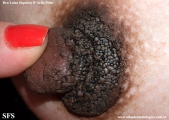 hyperkeratosis_of_ the_nipple_and_ areola