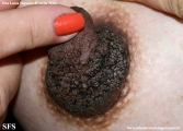 hyperkeratosis_of_ the_nipple_and_ areola