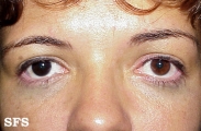 naevus of ota-bilateral type