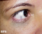 naevus of ota-bilateral type