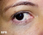 naevus of ota-bilateral type