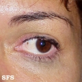 naevus of ota-bilateral type