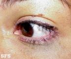 naevus of ota-bilateral type