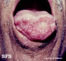 blastomycosis south american