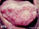 blastomycosis south american