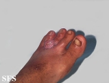 blastomycosis south american