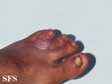 blastomycosis south american