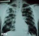 blastomycosis south american
