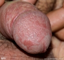 condyloma-flat_condyloma_of_the_penis