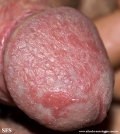 condyloma-flat_condyloma_of_the_penis