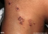 impetigo