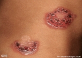 impetigo