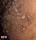impetigo