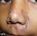 impetigo