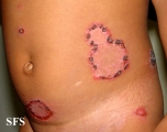 impetigo