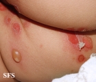 impetigo