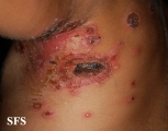 impetigo