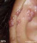 angiolymphoid hyperplasia with eosinophilia