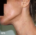 darier's disease-linear darier's disease
