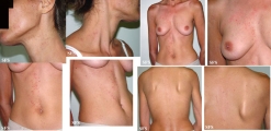darier's disease-linear darier's disease