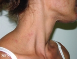 darier's disease-linear darier's disease
