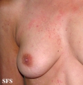 darier's disease-linear darier's disease